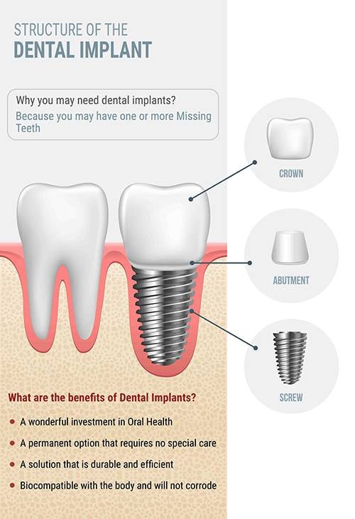 Structure Of The Dental Implant Dentist Oakland Park FL