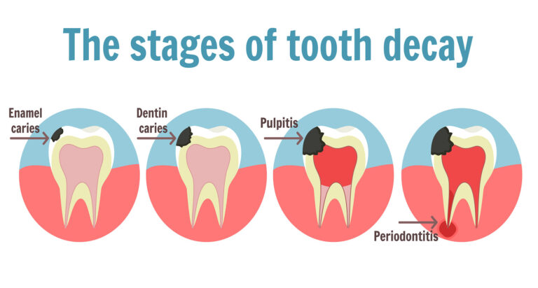 the-stages-of-tooth-decay-dentist-oakland-park-fl